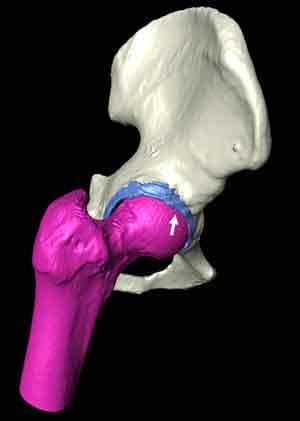 Hip Cartilage-5th view