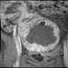 MR image of uterine fibroids immediately after MRgFUS