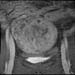 MR image of uterine fibroids before MRgFUS