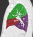 Lobar lung segmentation - side