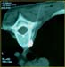 Image of needle inserted into the 3rd thoracic vertebra