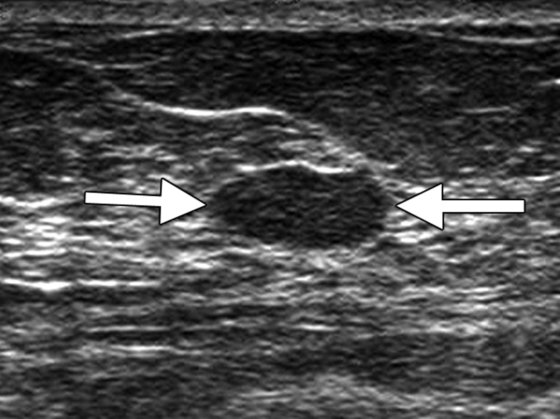 RSNA press release: Annual Screening with Breast Ultrasound or MRI Could Benefit Some Women